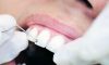 Zobobol je najpogostejša bolečina v ustni votlini